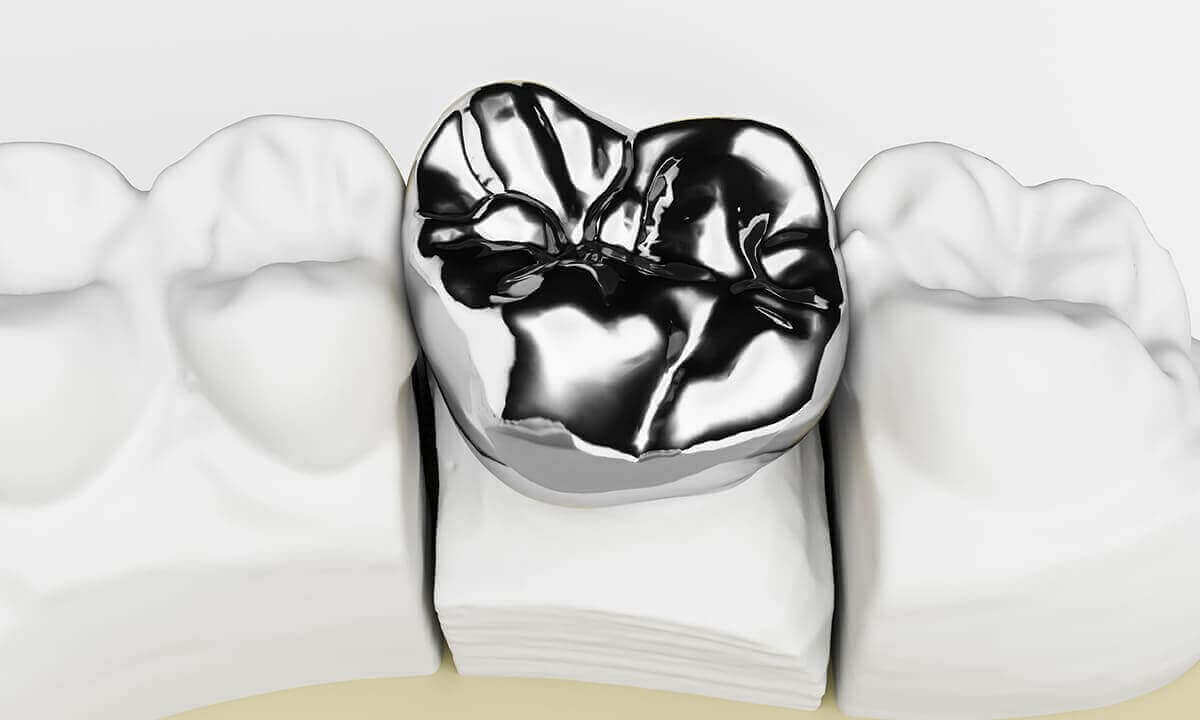 銀歯（保険診療）