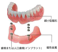 マグネットインプラントデンチャー