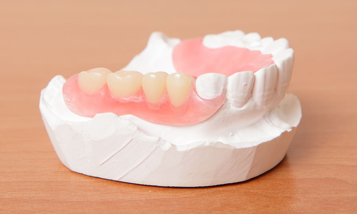 バネを使わず床で固定するナイロン弾性樹脂製義歯