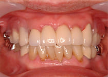 アタッチメントタイプの入れ歯
