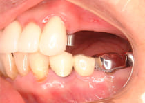 アタッチメントタイプの入れ歯