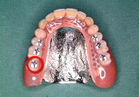精密義歯（入れ歯）｜先進的な機器で治療を行なう東住吉のさいのき歯科