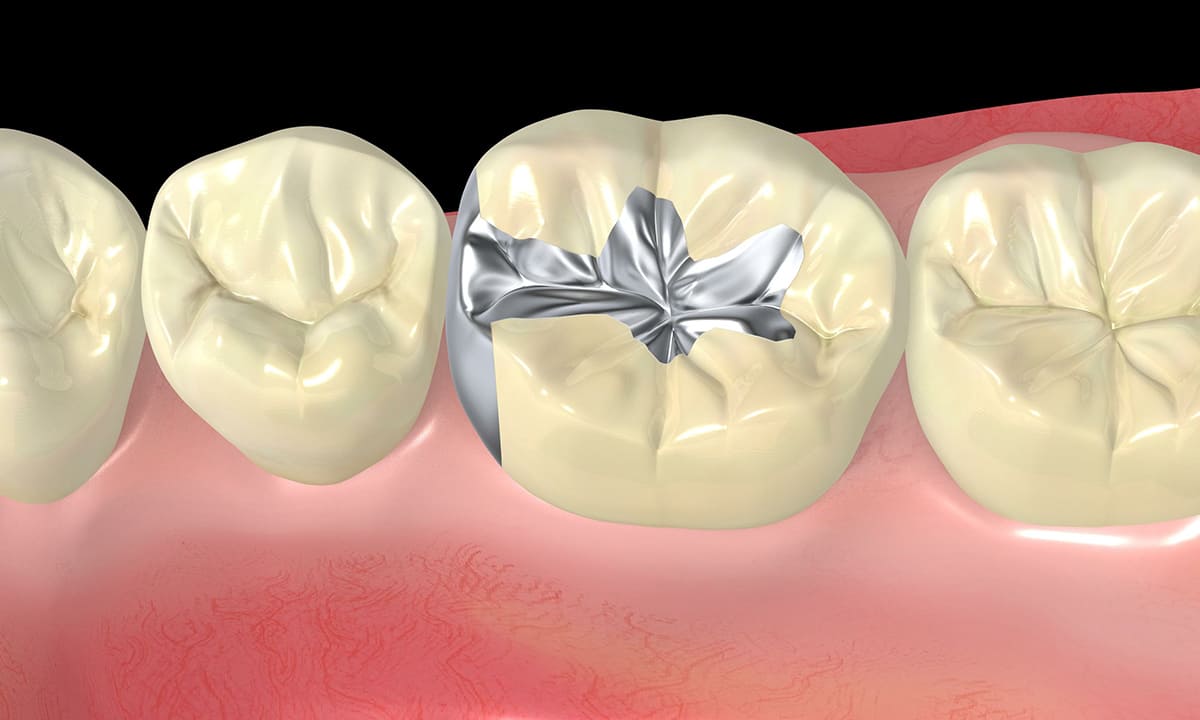 銀色の詰め物・被せ物