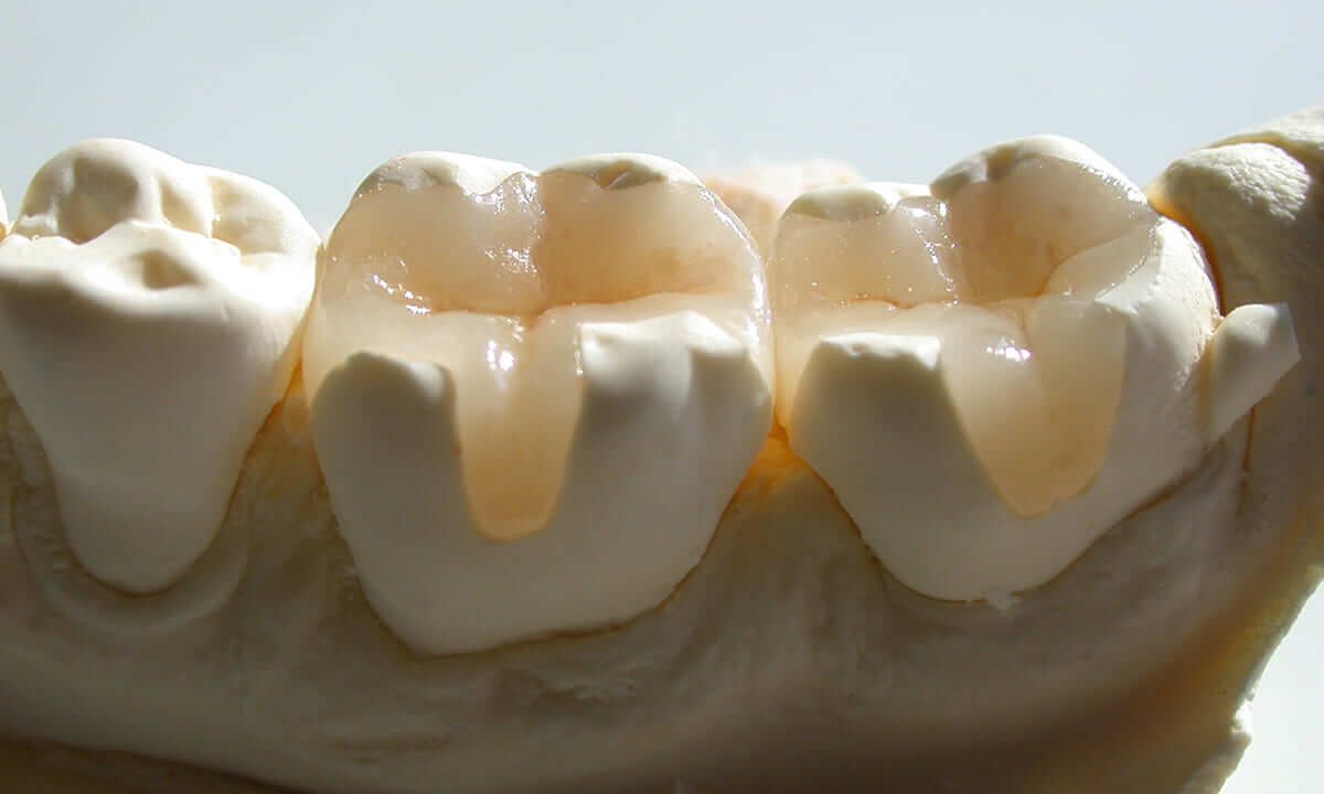 当院ではより自然で天然歯に近いセラミックによる治療も行なっています