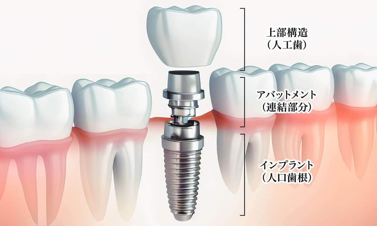 歯科用インプラントの基本構造