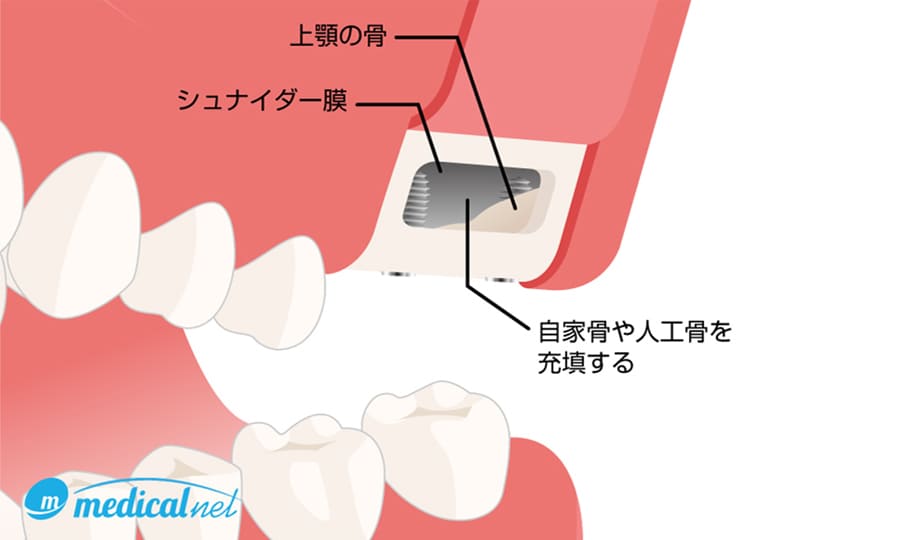 サイナスリフト(上顎洞底挙上術)