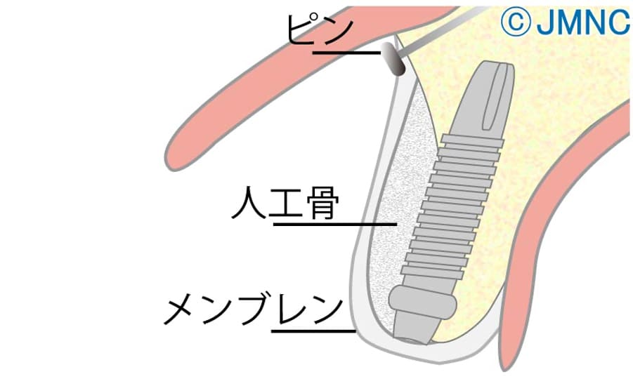 GBR法(骨再生誘導法)