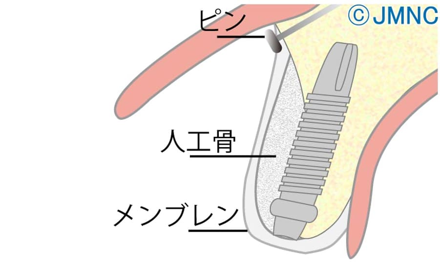 GBR法（骨再生誘導法）