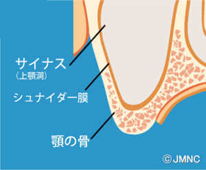 歯肉と骨の切開、顎洞底の挙上