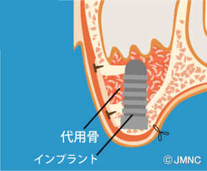 骨充填材とインプラントの埋入・縫合