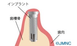 インプラントの埋入