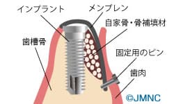 自家骨または骨充填材を入れ、メンブレンで覆う