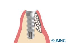 歯肉を戻し、骨の再生を待つ