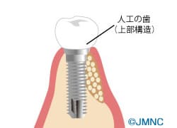 上部構造の取り付け